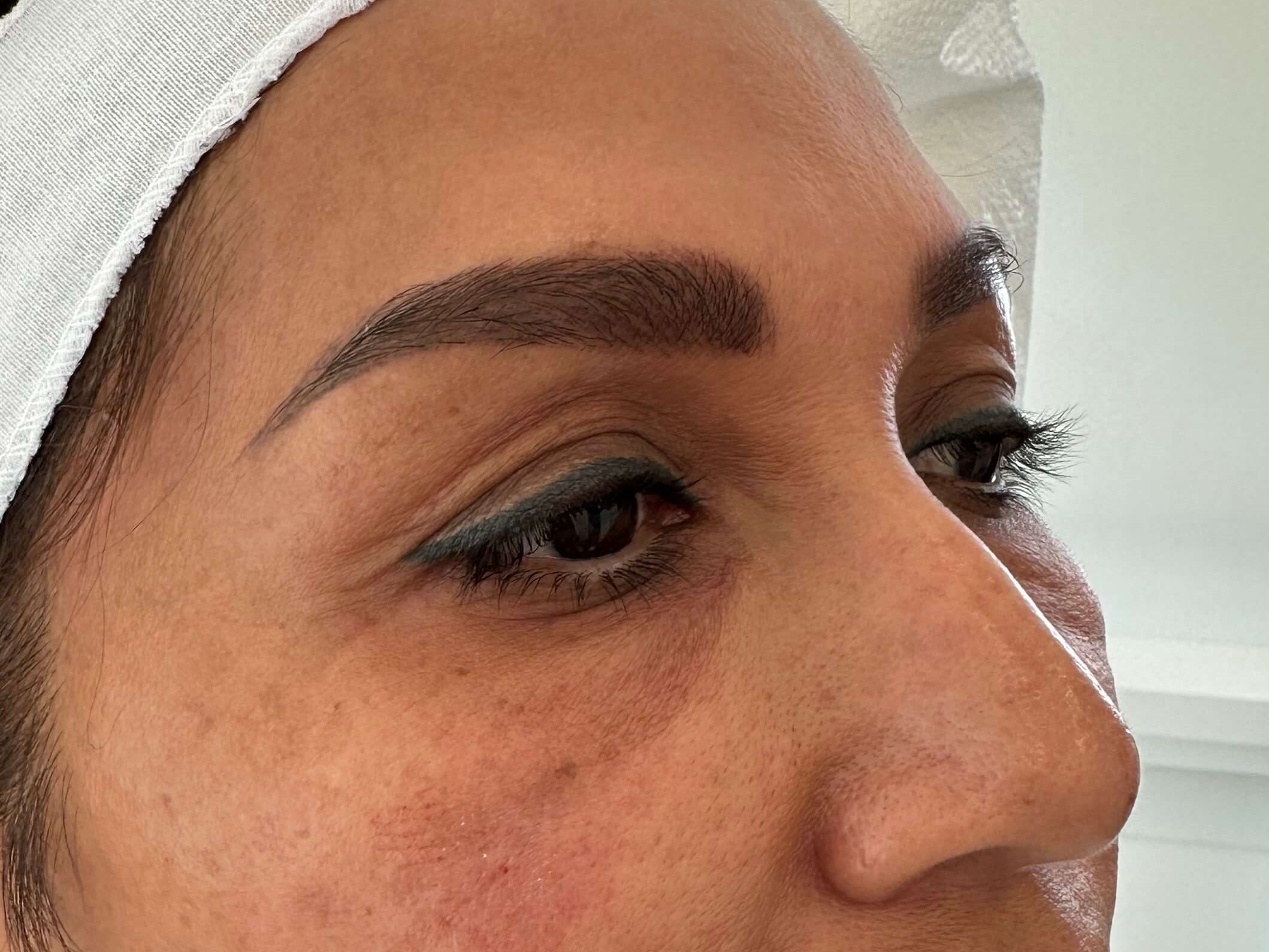Undereye Filler, Juvederm After