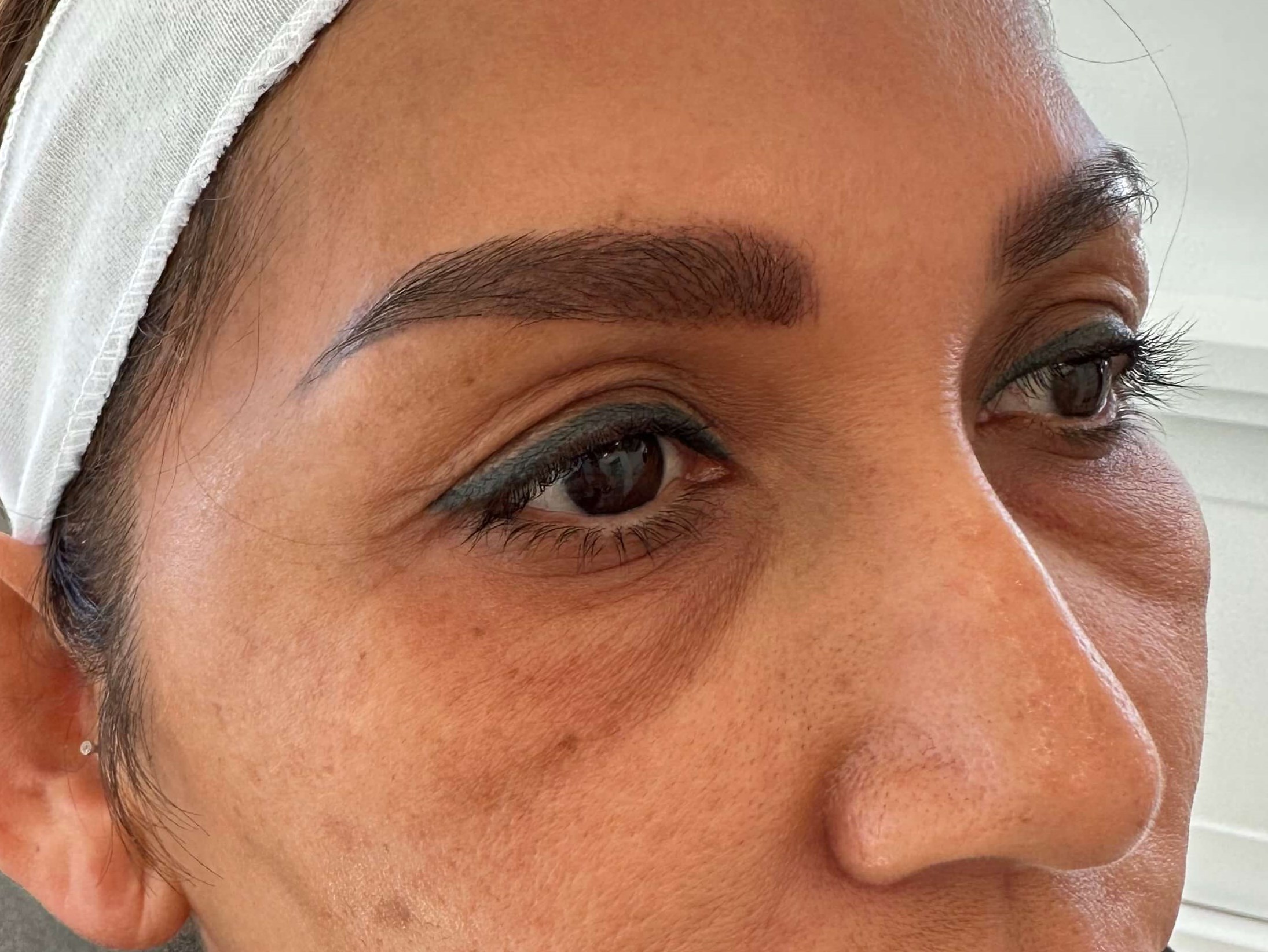 Undereye Filler, Juvederm Before