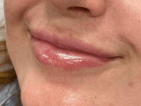 Juvederm Ultra, Lip Filler After