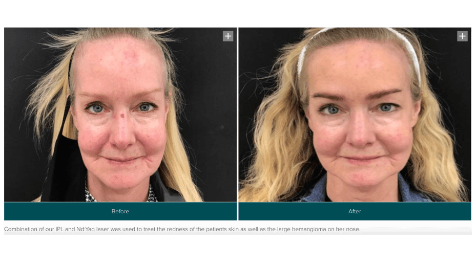 Before and after rosacea treat