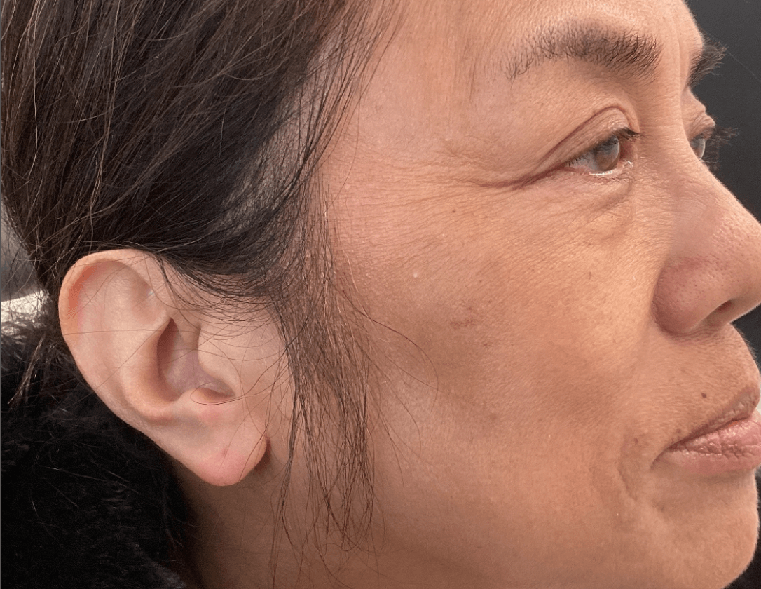 Hyperpigmentation/Melasma After