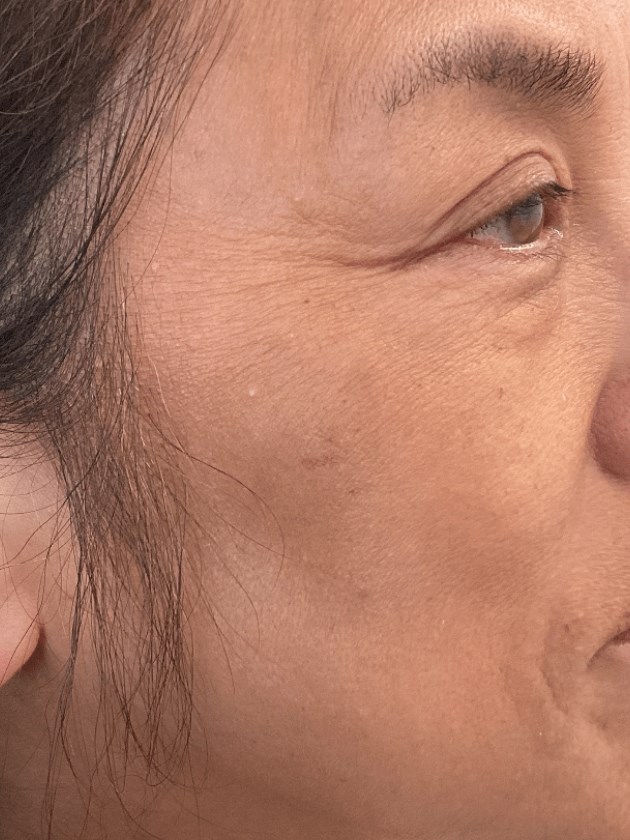 Hyperpigmentation/Melasma After