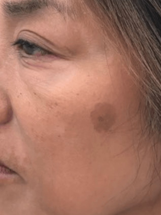 Hyperpigmentation/Melasma Before