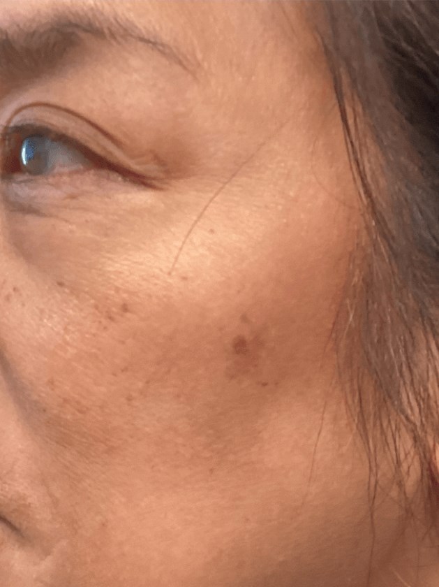 Hyperpigmentation/Melasma After
