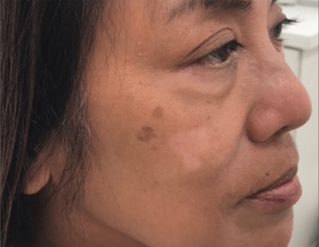 Hyperpigmentation/Melasma Before