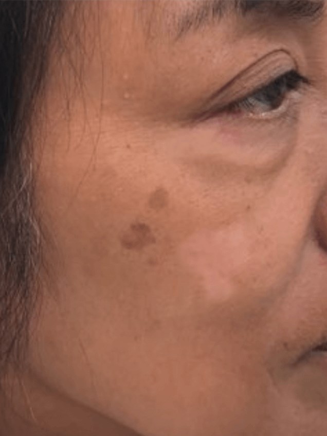 Hyperpigmentation/Melasma Before
