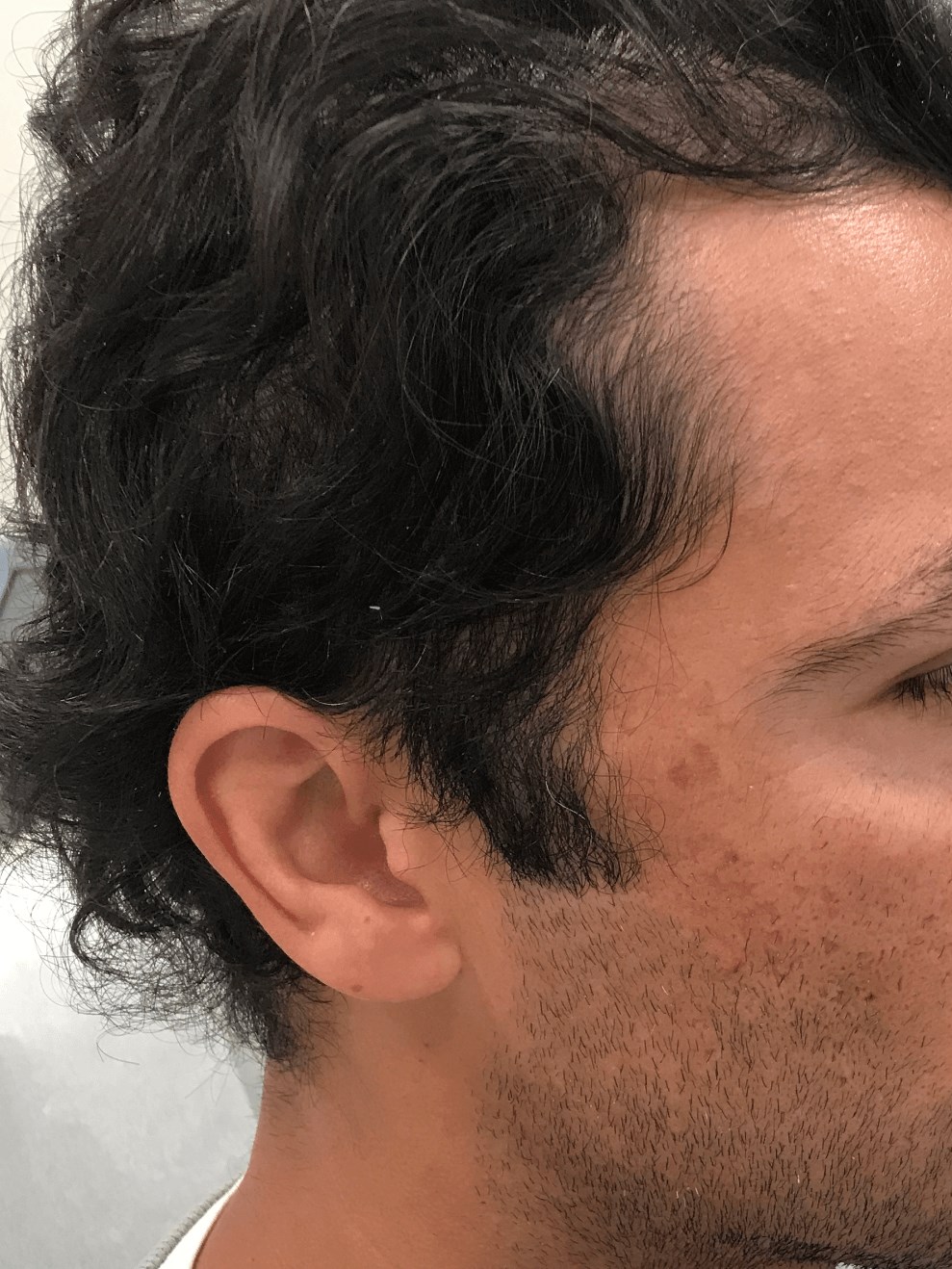 Alopecia Treatment After