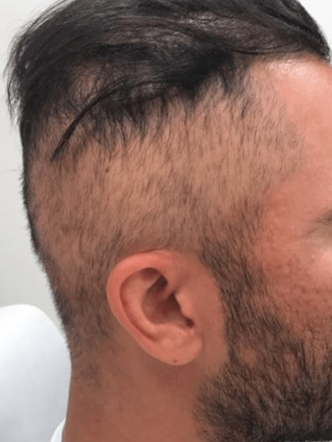 Alopecia Treatment Before