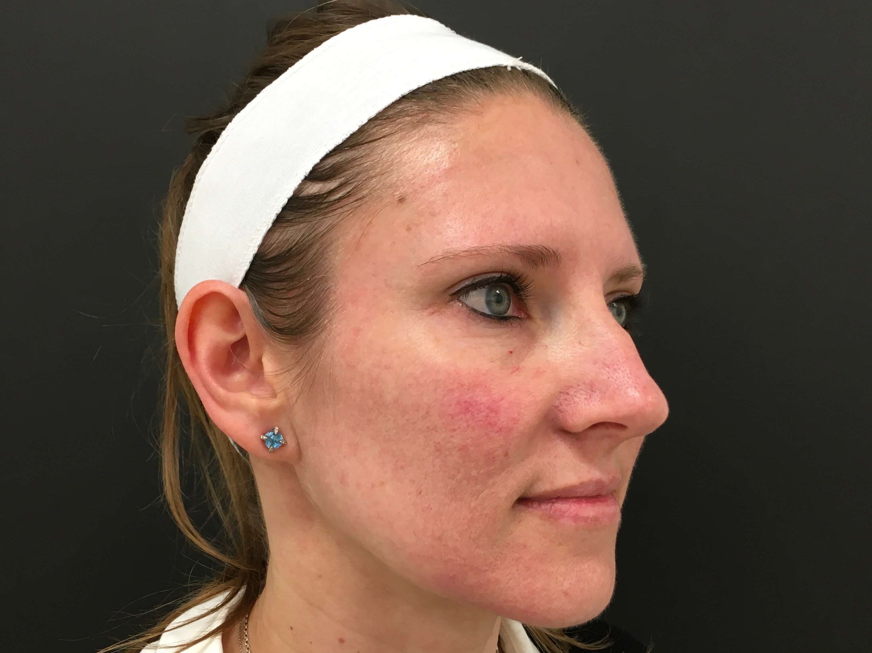 Laser Therapy for Redness Before