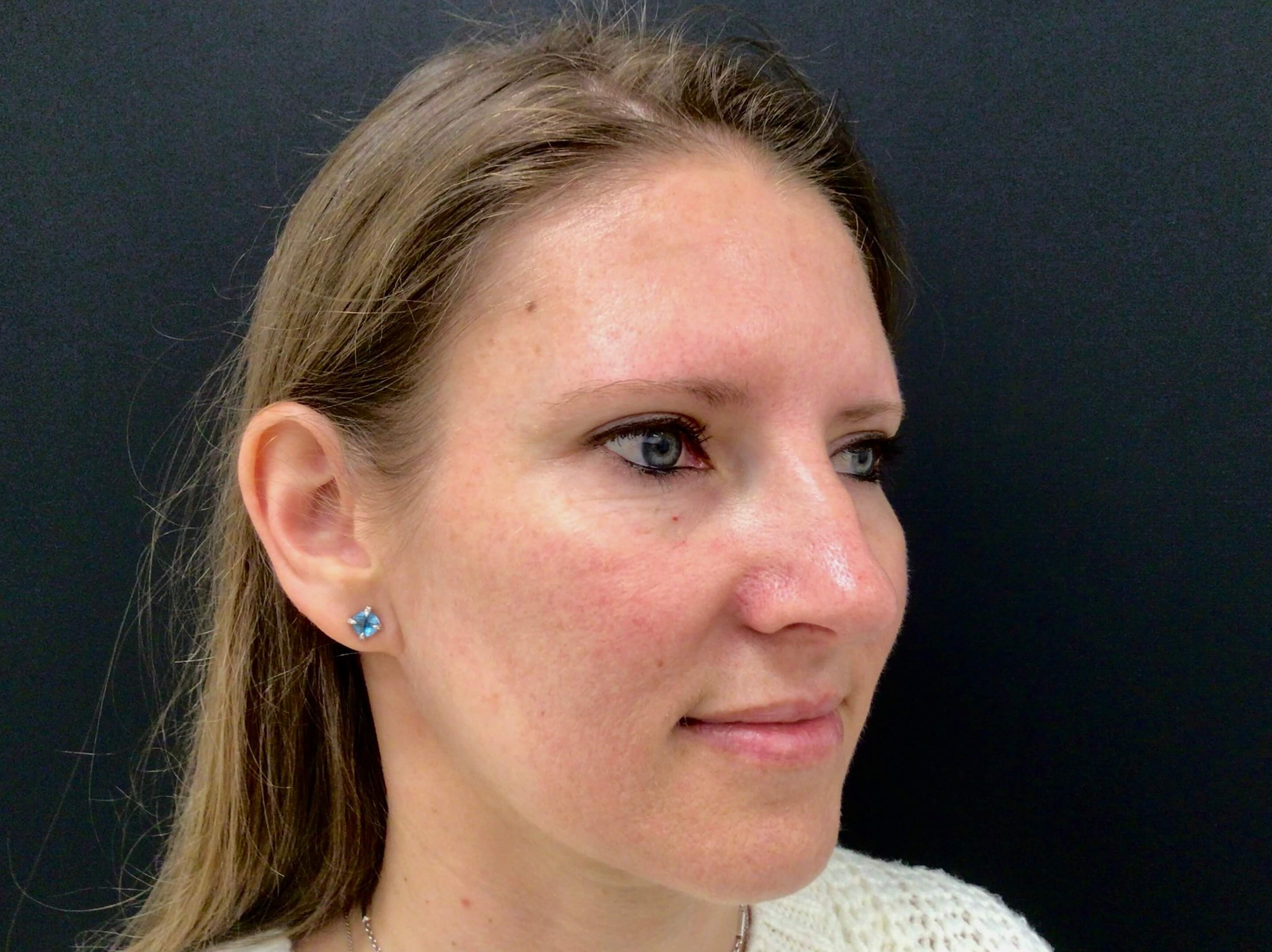 Laser Therapy for Redness After