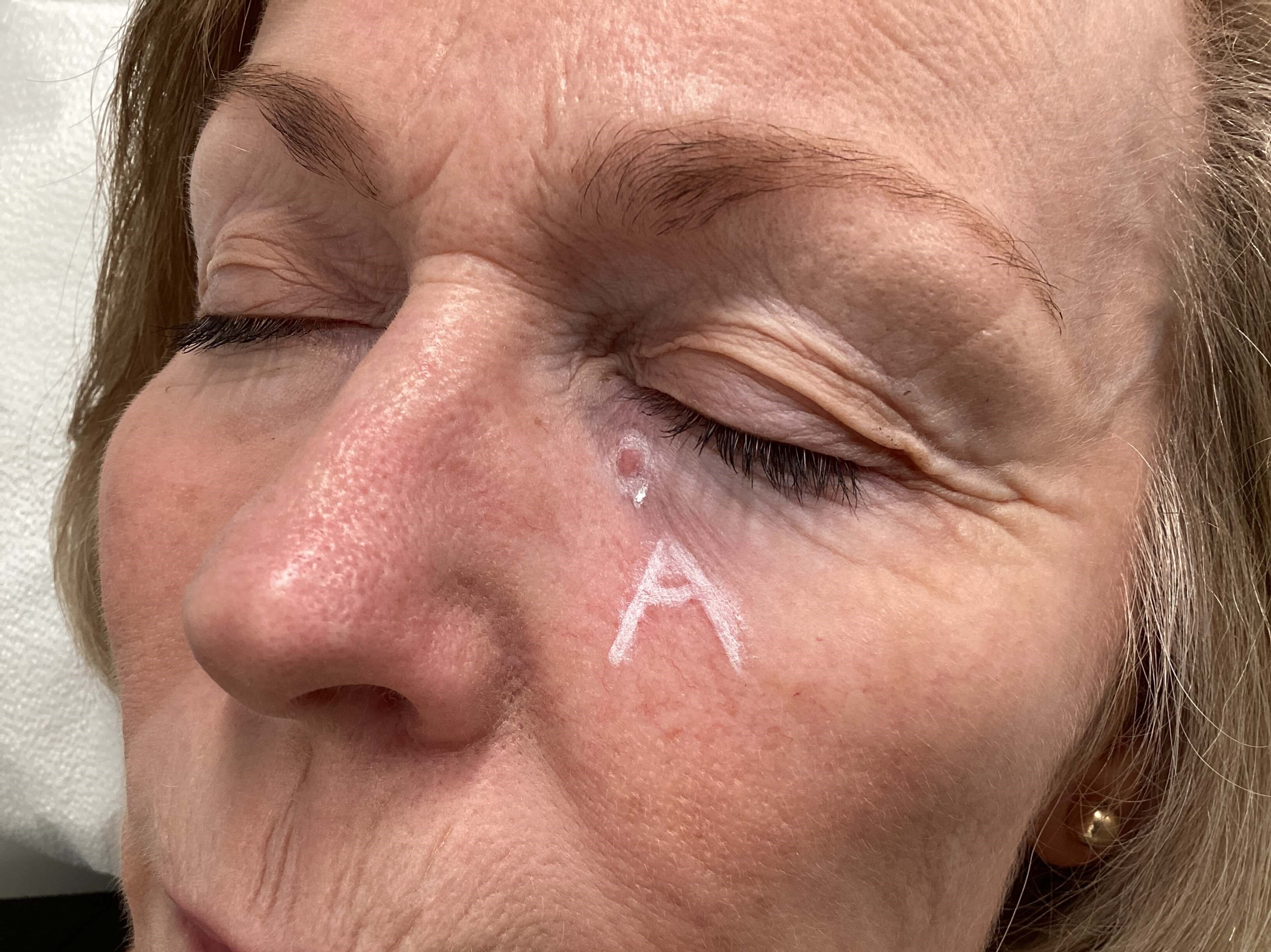 Skin Cancer Identified Before