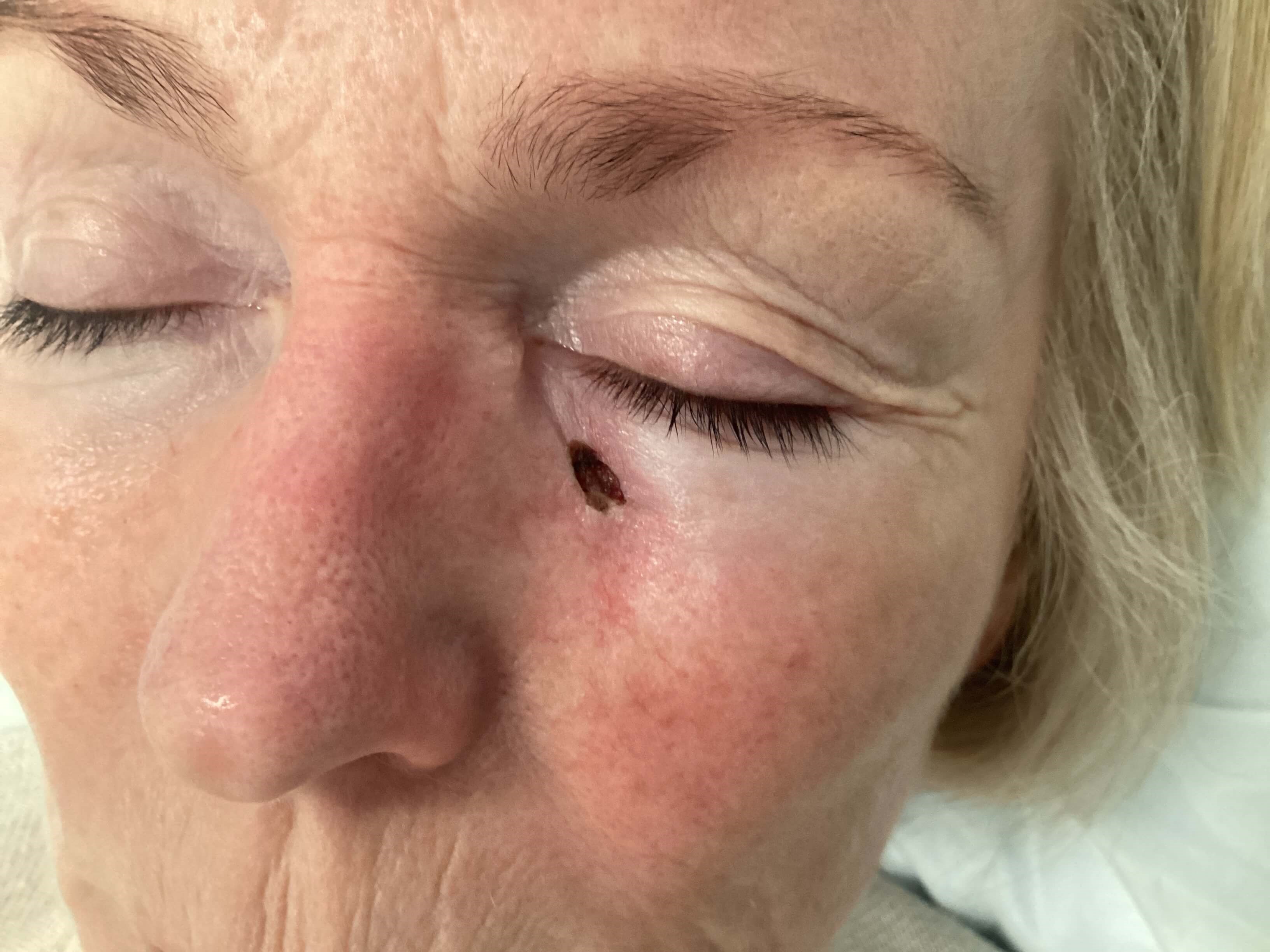 Skin Cancer Identified After