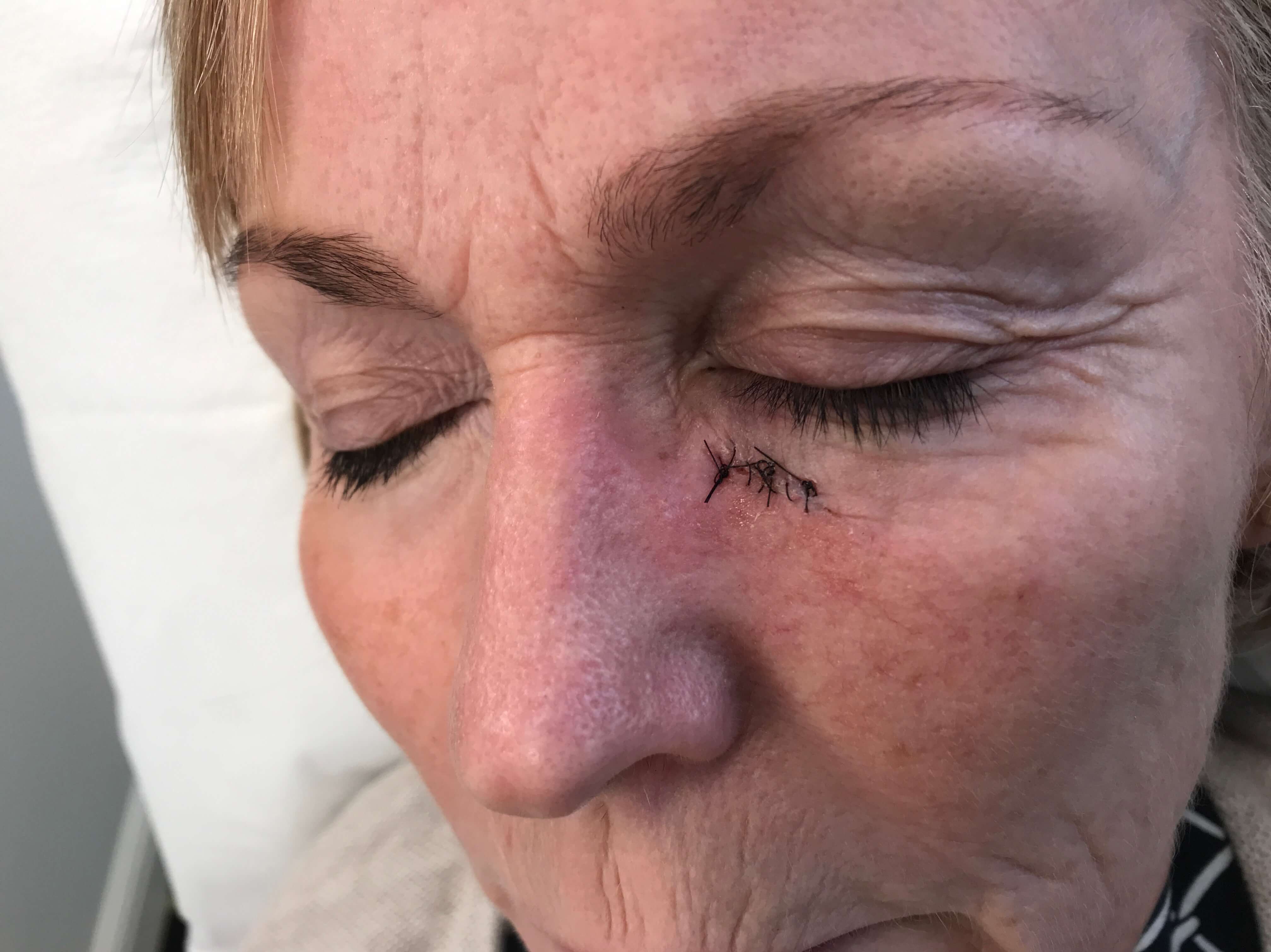 Skin Cancer Excised and Healed Before