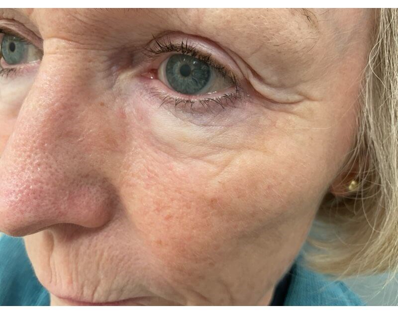 Skin Cancer Excised and Healed After