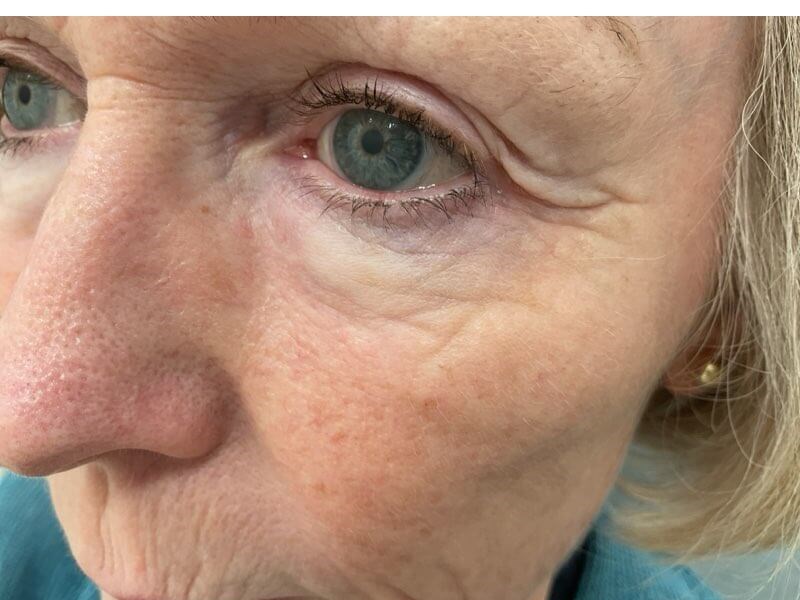 Skin Cancer Excised and Healed After