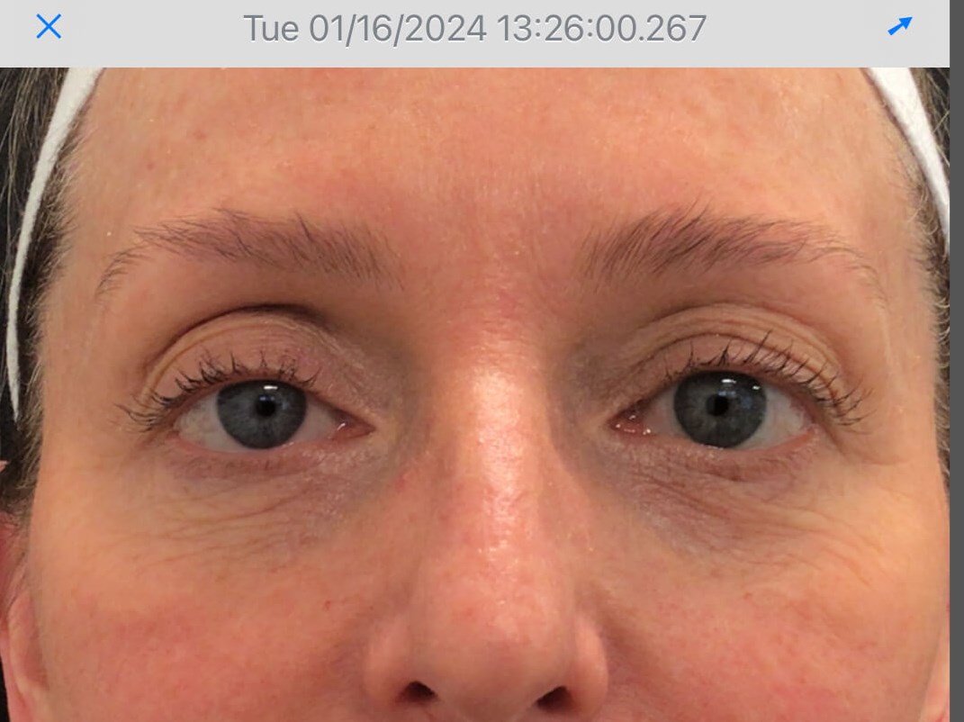 Improved undereyes 8 Weeks After