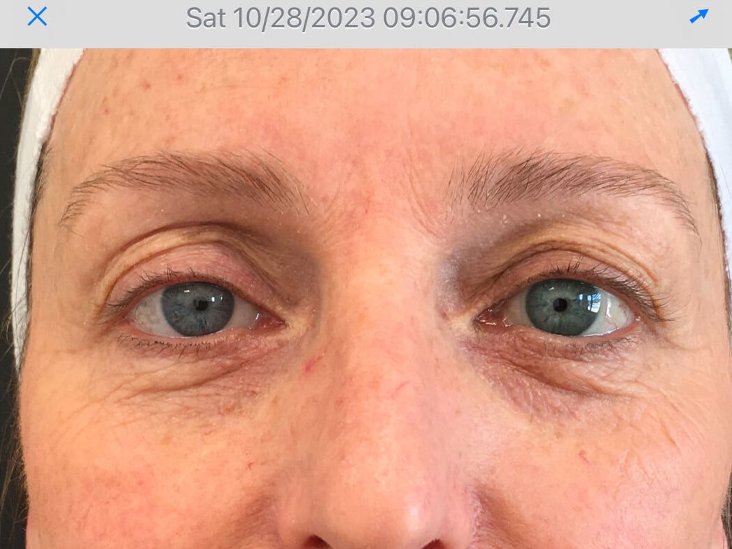Improved undereyes Before
