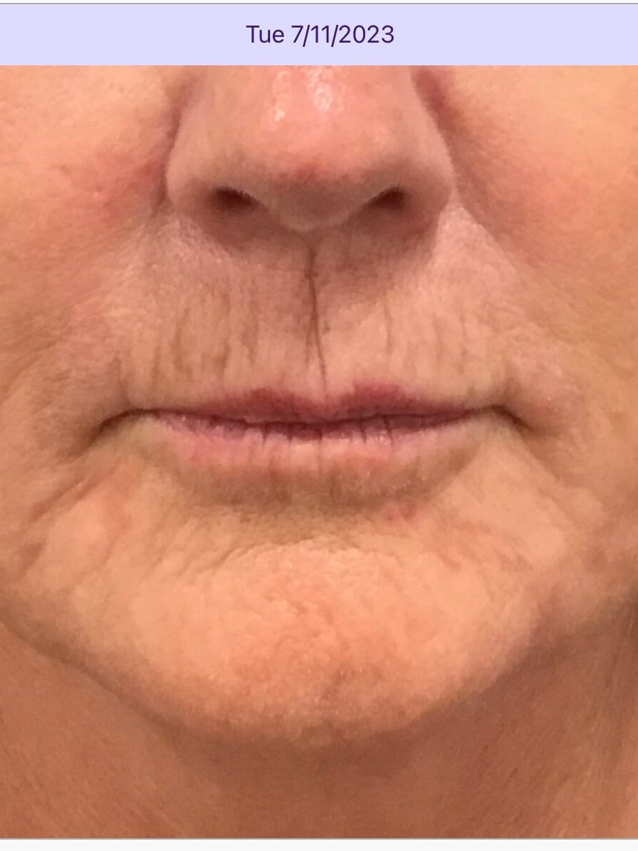 Vertical Lip Lines Treatment Before