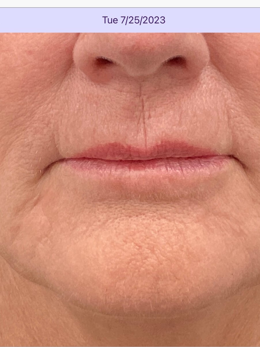 Vertical Lip Lines Treatment After