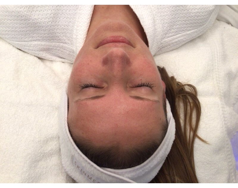 HydraFacial for Redness Before