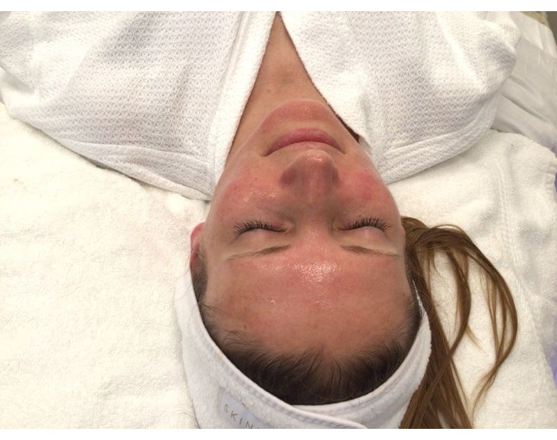 HydraFacial for Redness After