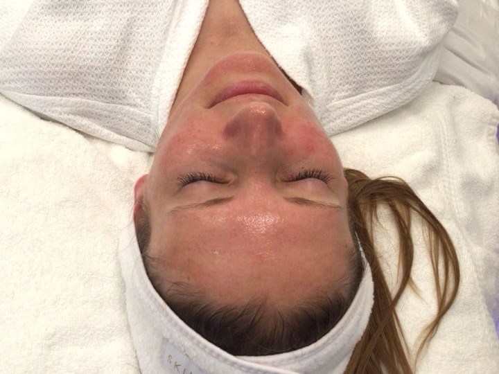 HydraFacial for Redness After