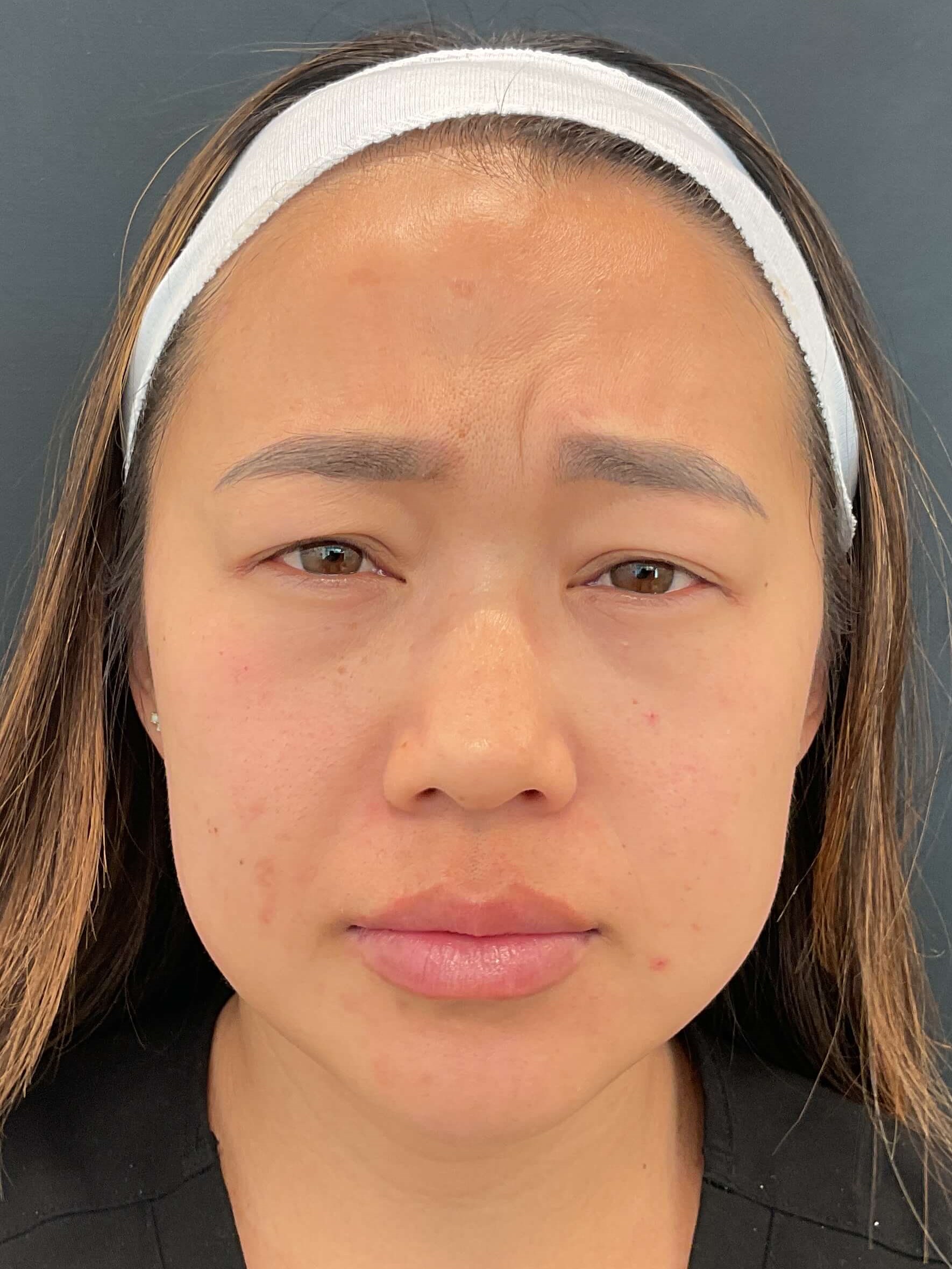 Before and After Photos Before