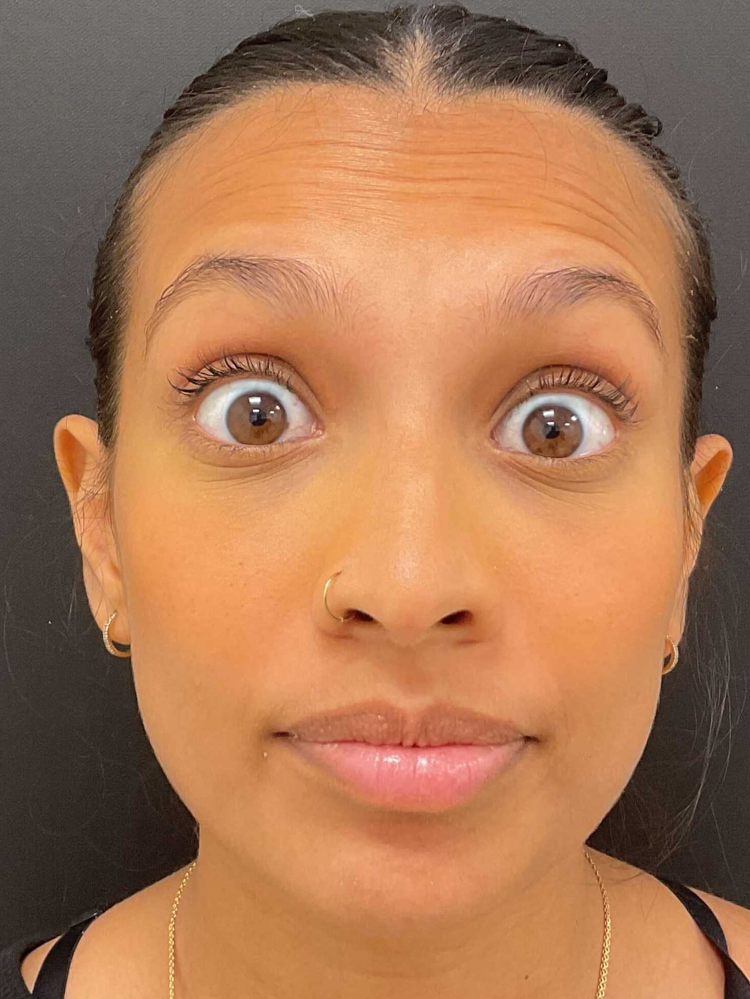 Before and After Photos Before