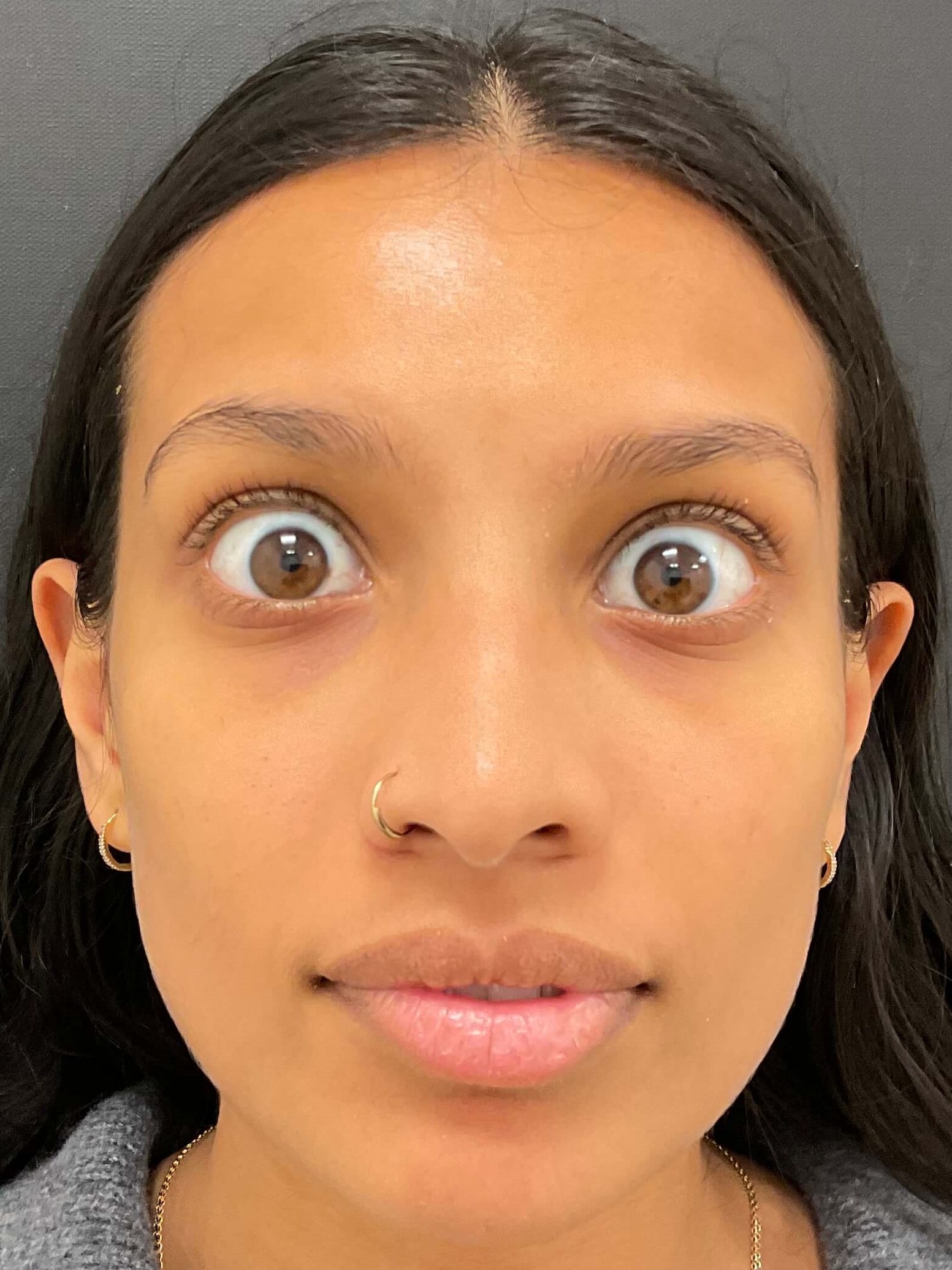 Before and After Photos After