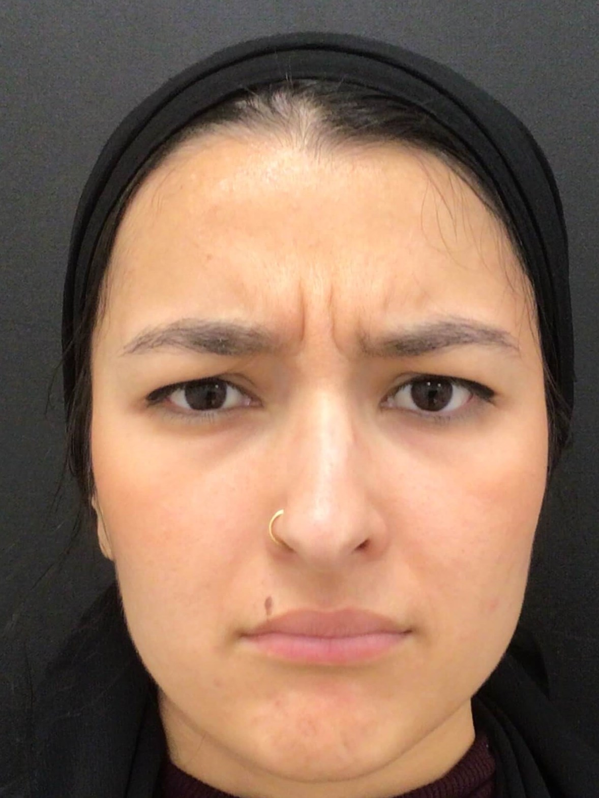 Before and After Photos Before