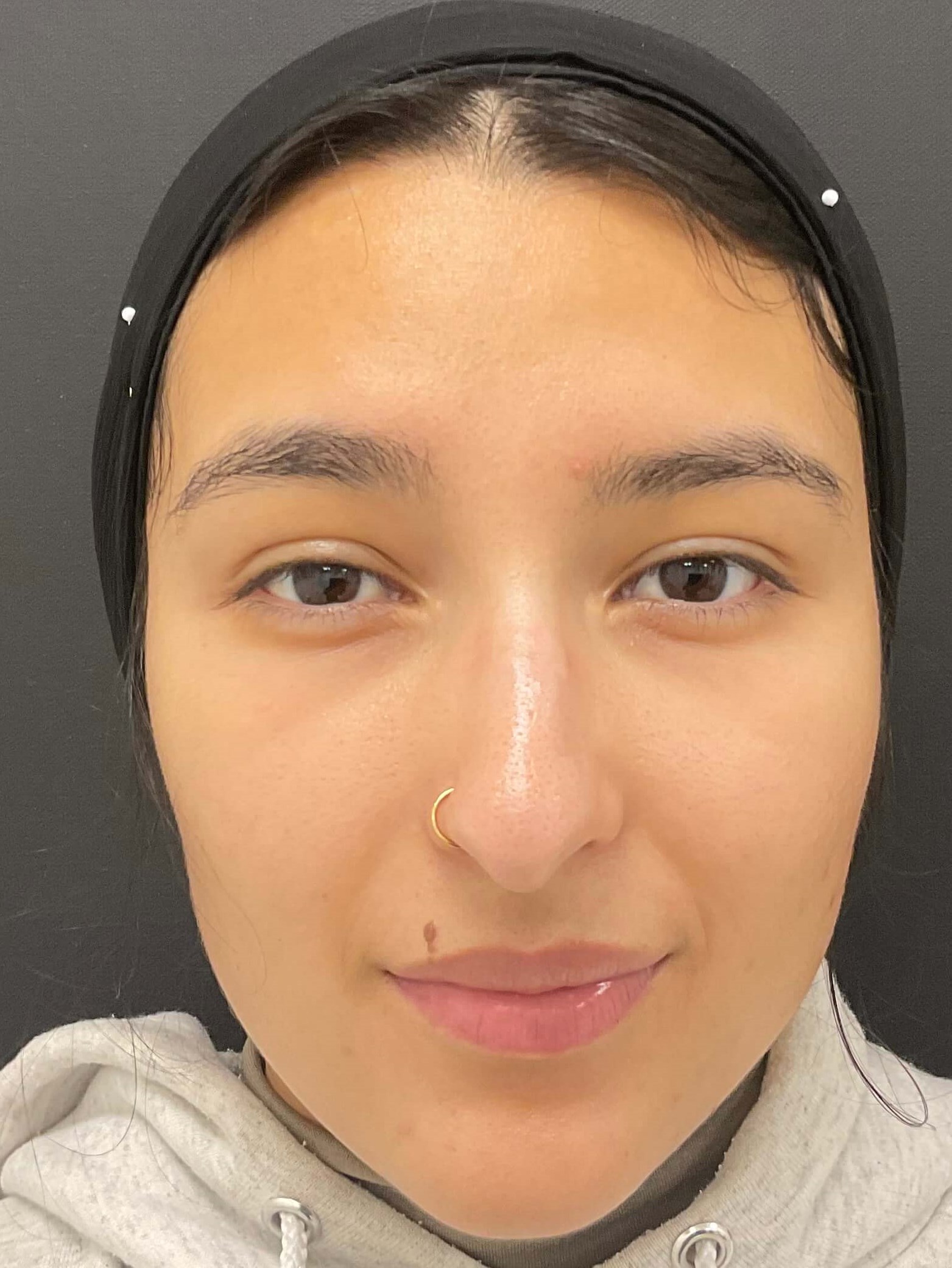 Before and After Photos After