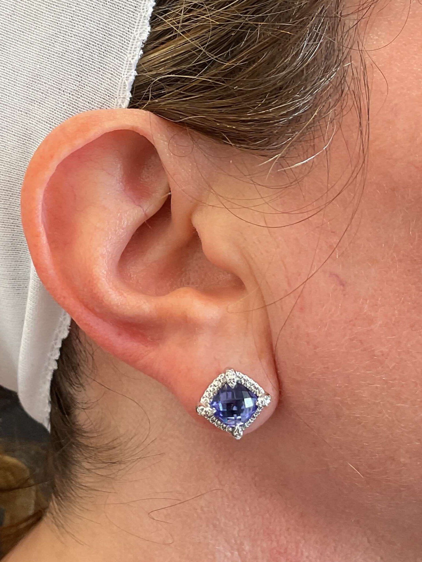 Ear Lobe Filler Results Before