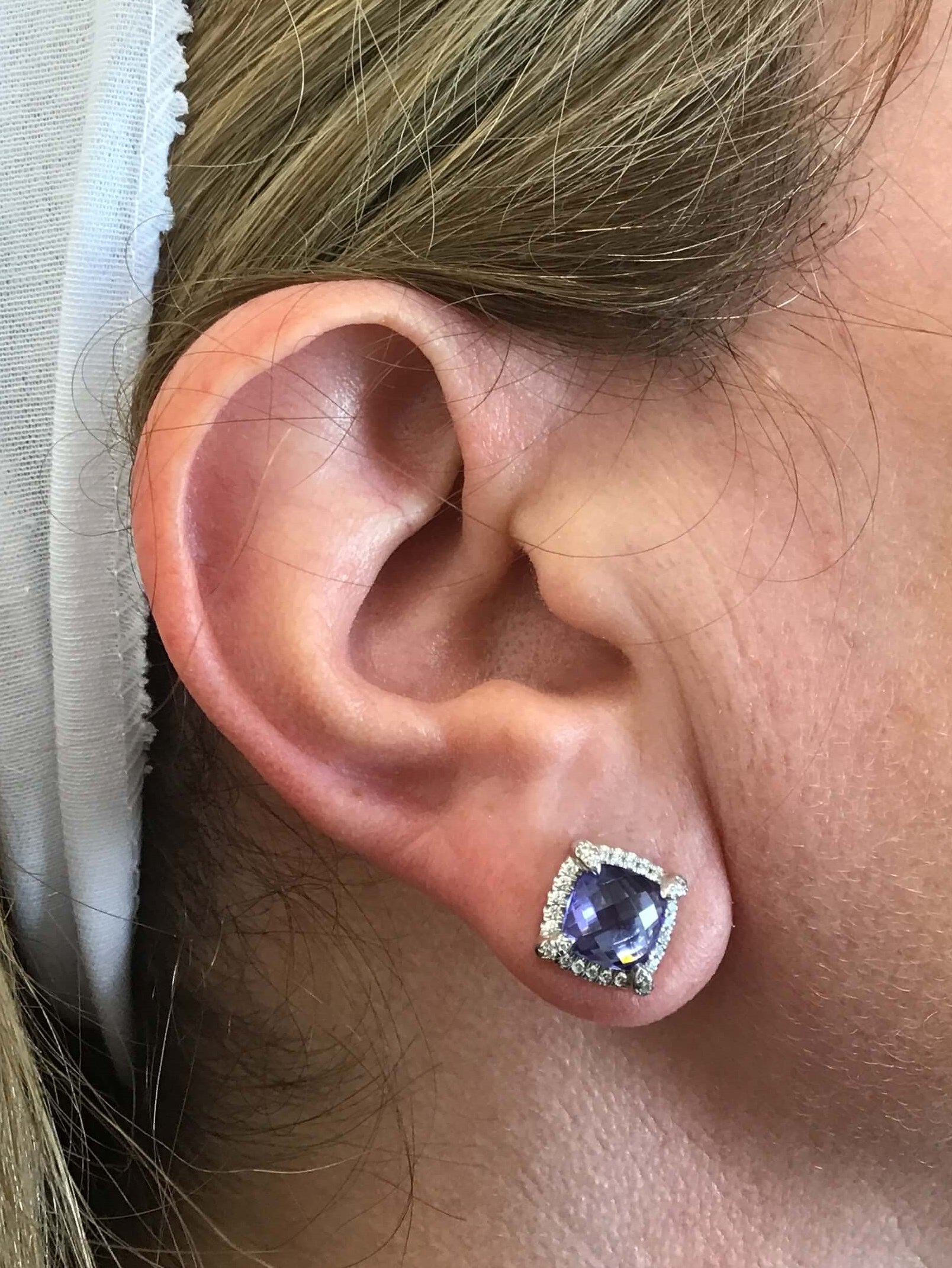 Ear Lobe Filler Results After