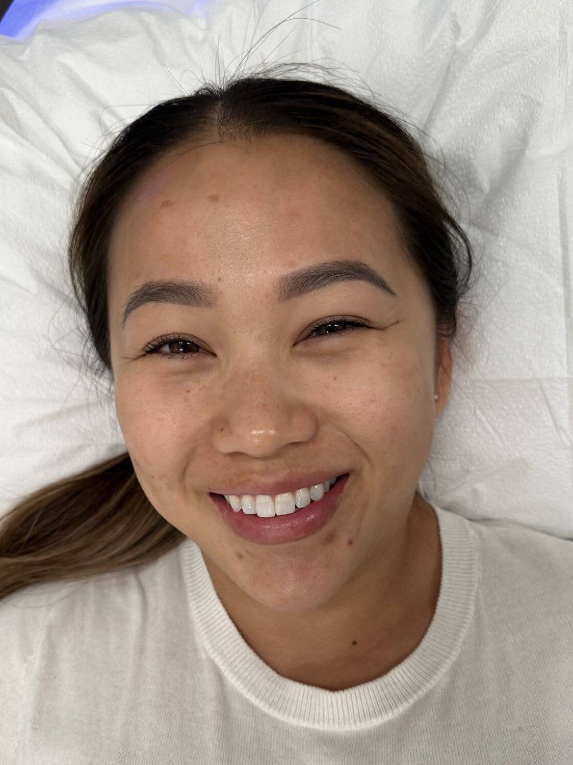 Chemical Peel for PIH Before