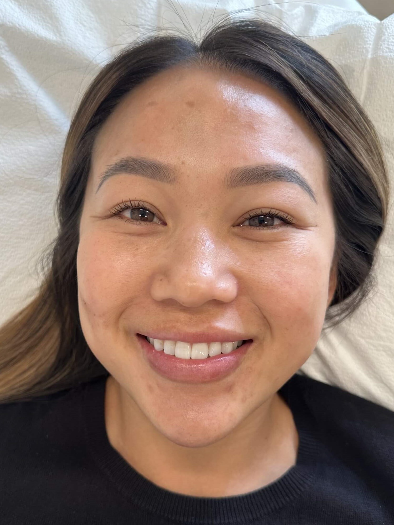 Chemical Peel for PIH After