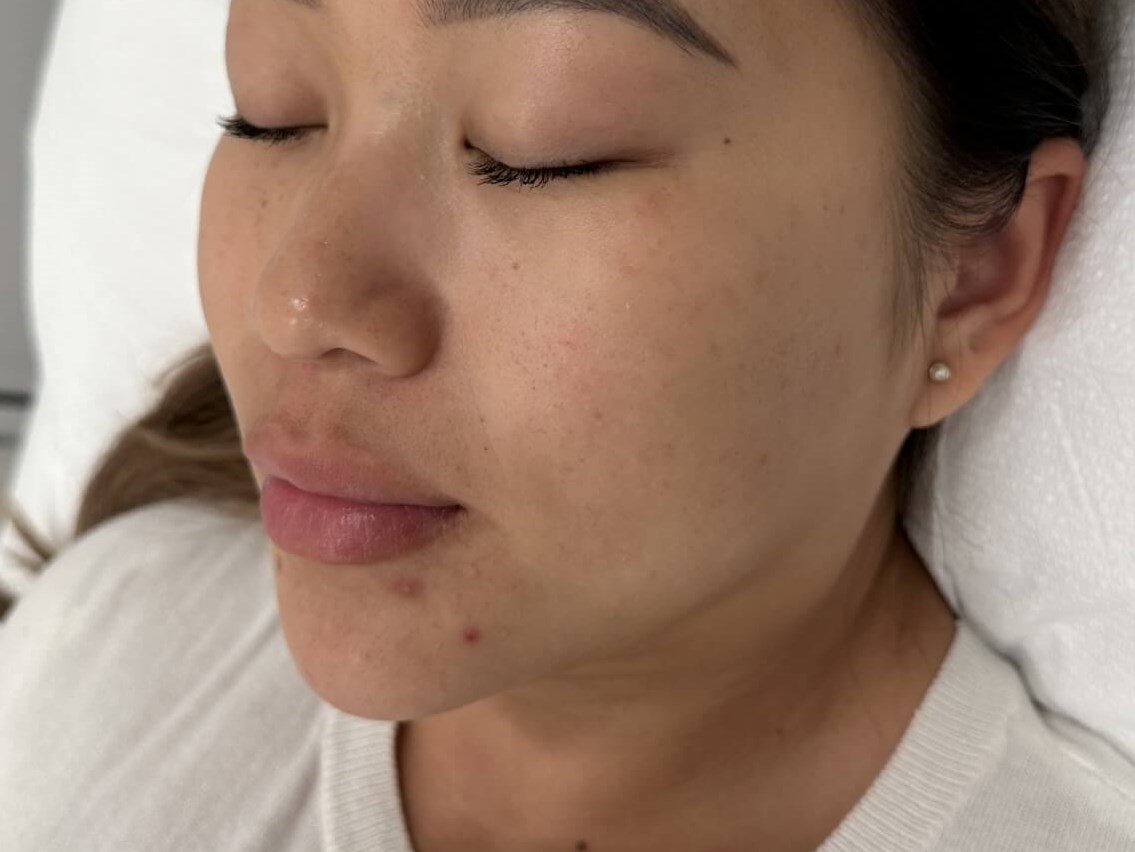 Chemical Peel for PIH Before