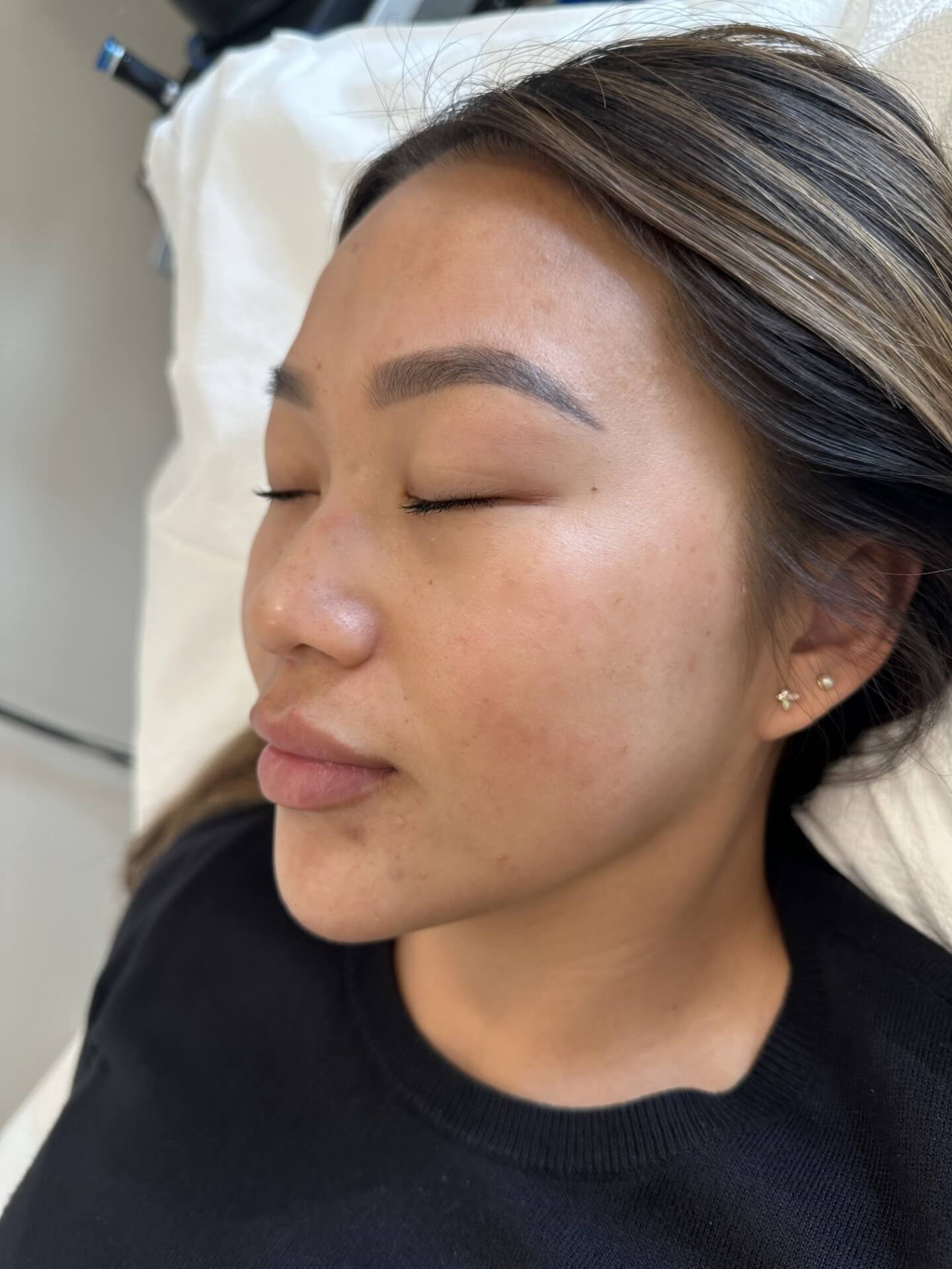 Chemical Peel for PIH After