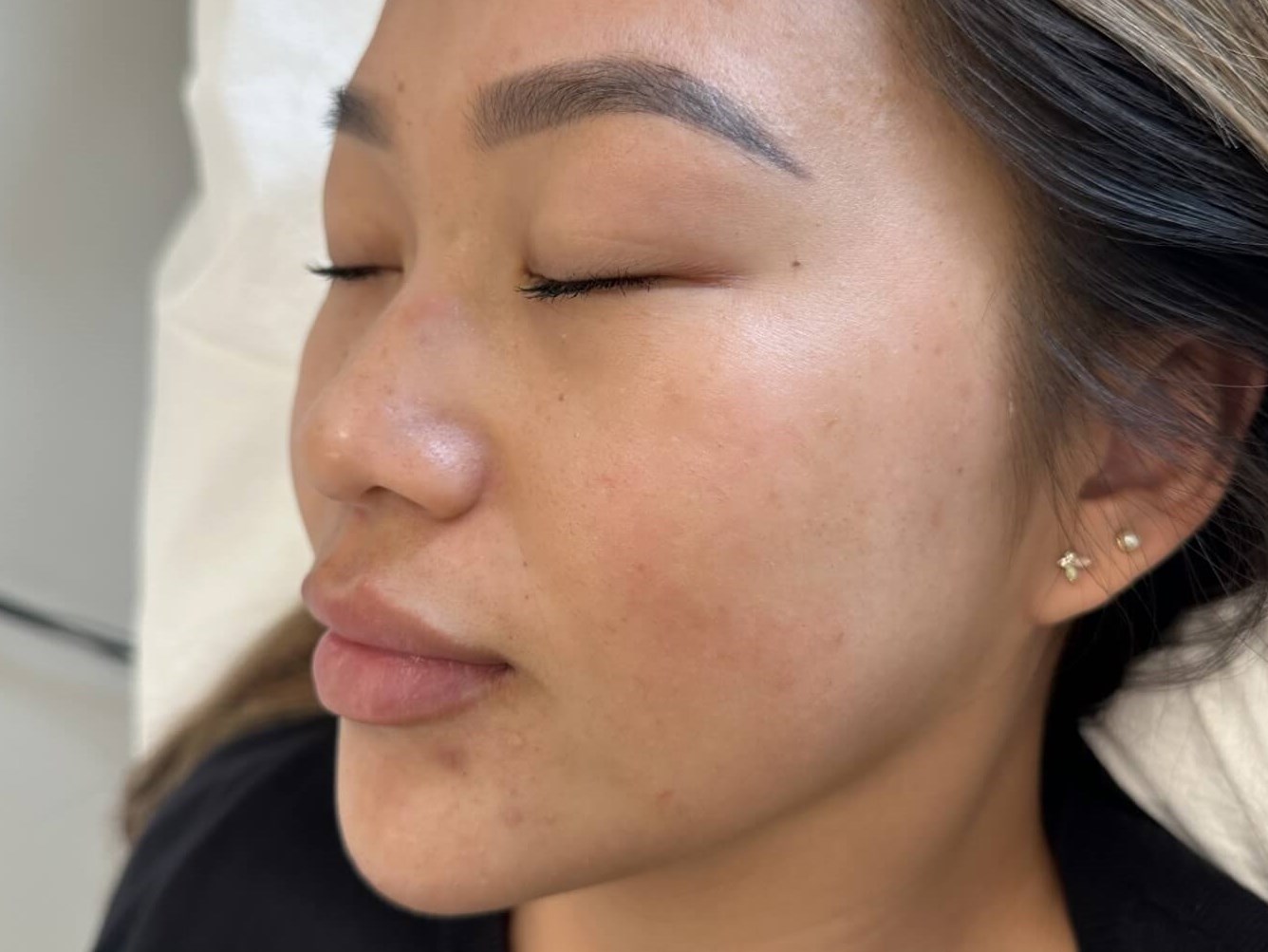 Chemical Peel for PIH After