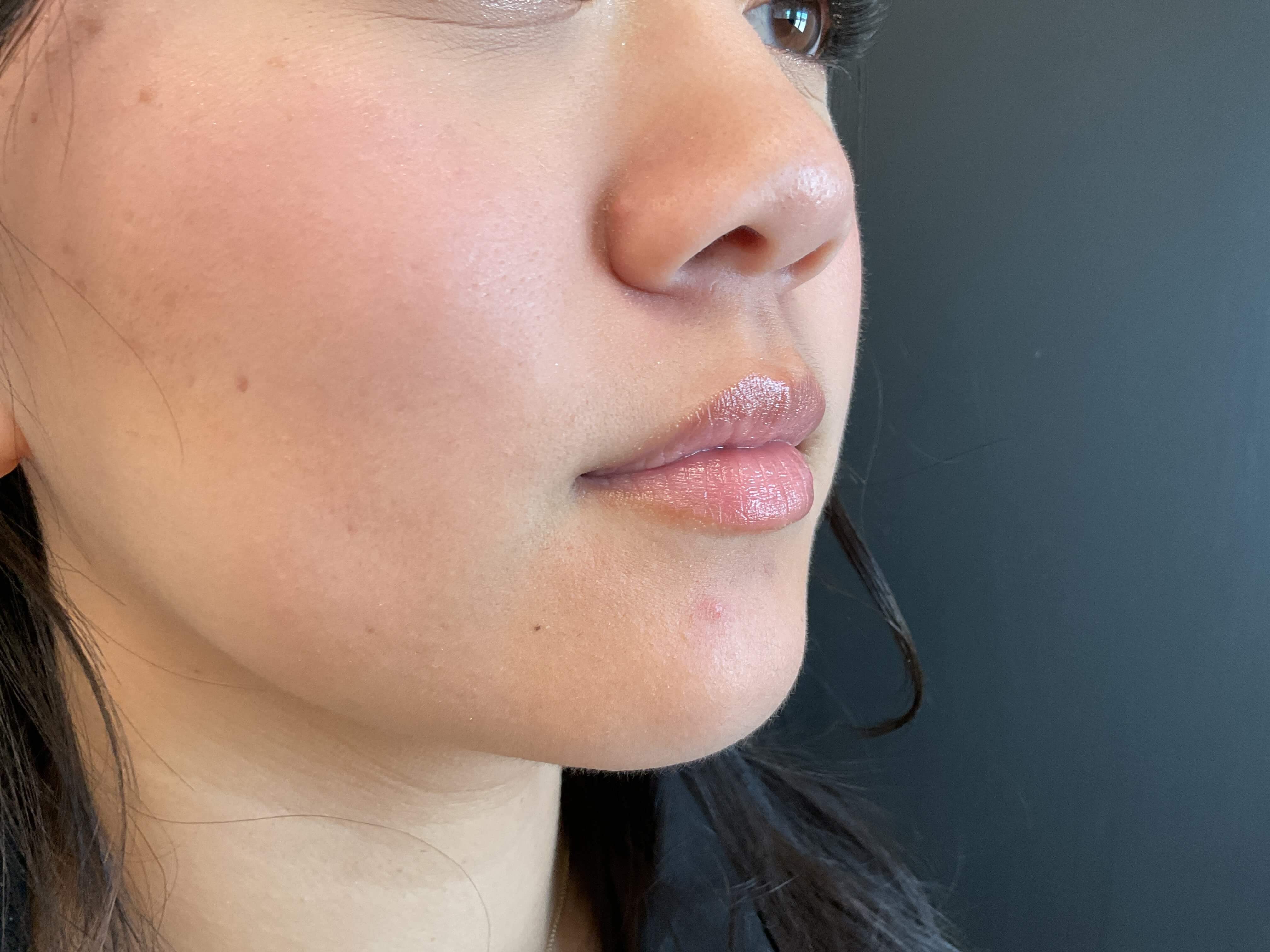 Lip filler, Juvéderm Volbella Before