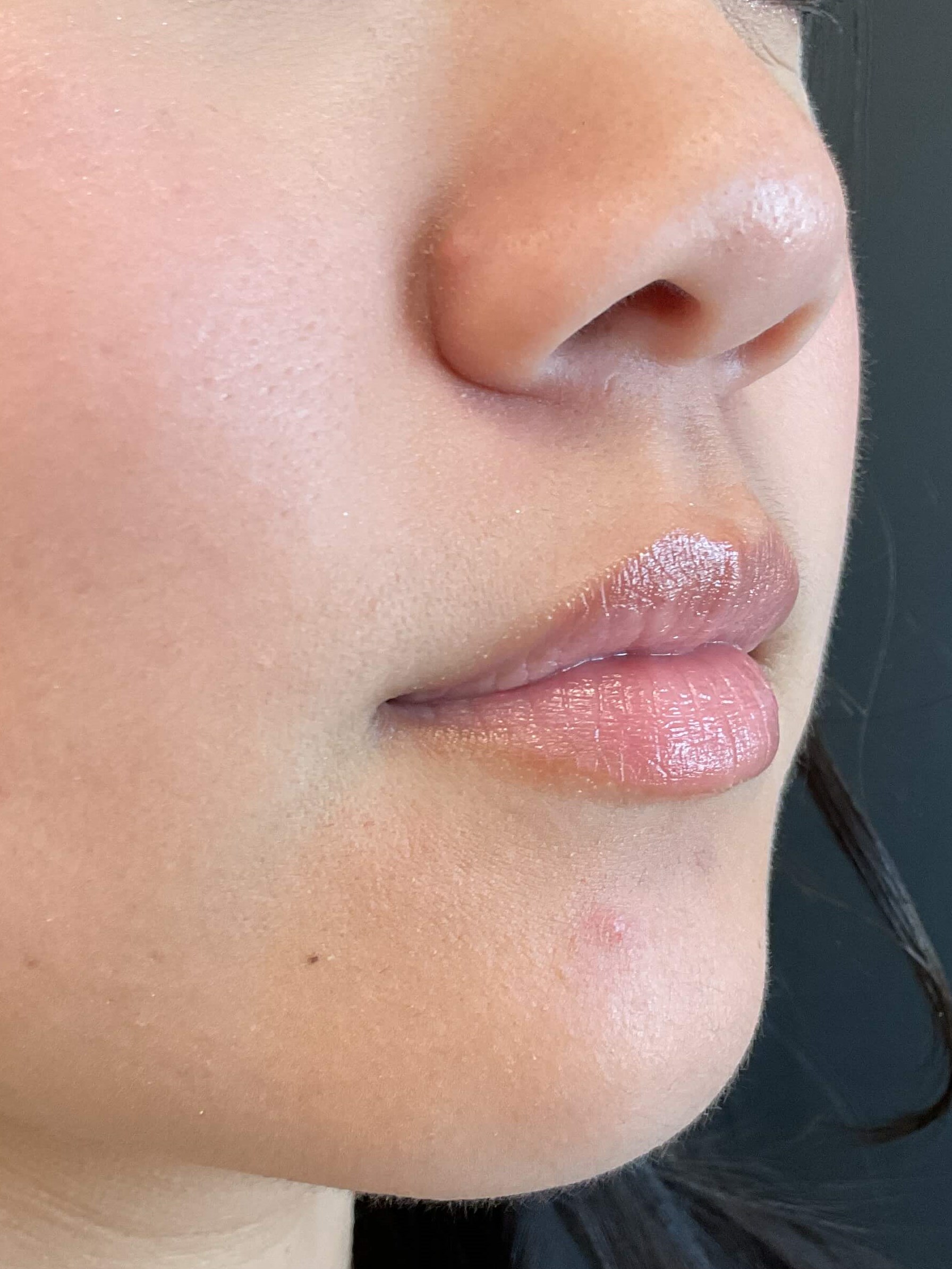 Lip filler, Juvéderm Volbella Before