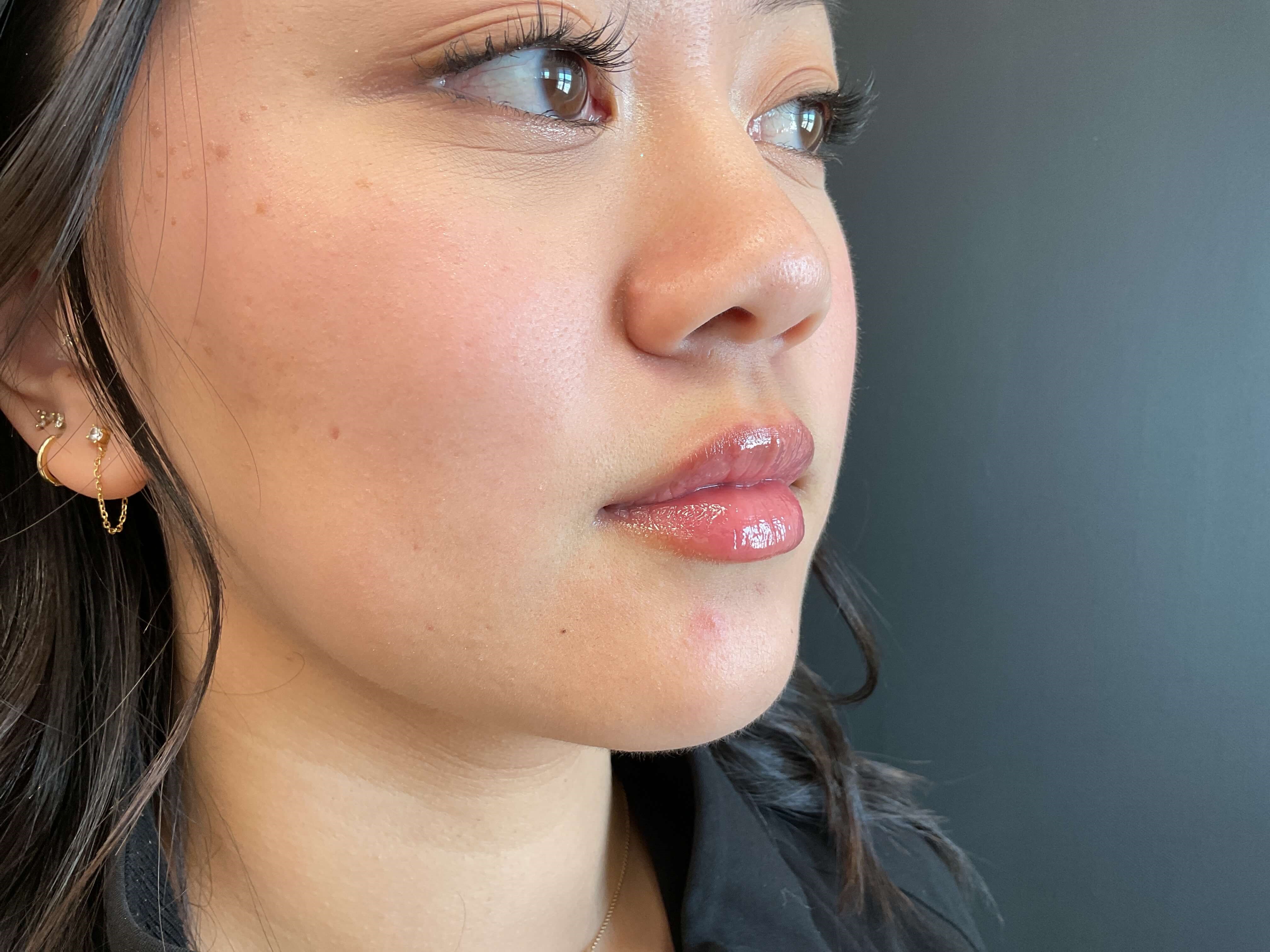 Lip filler, Juvéderm Volbella After