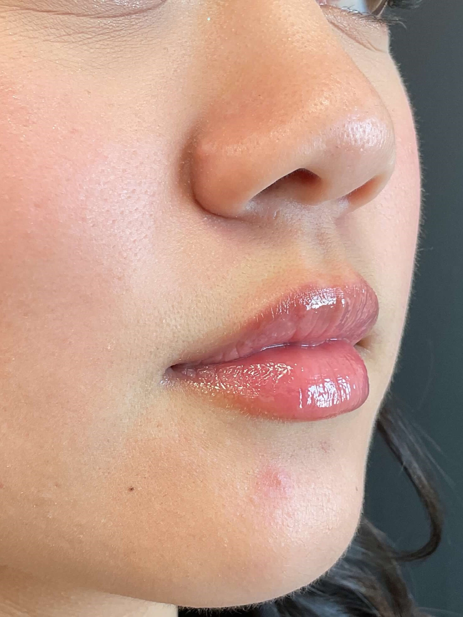 Lip filler, Juvéderm Volbella After