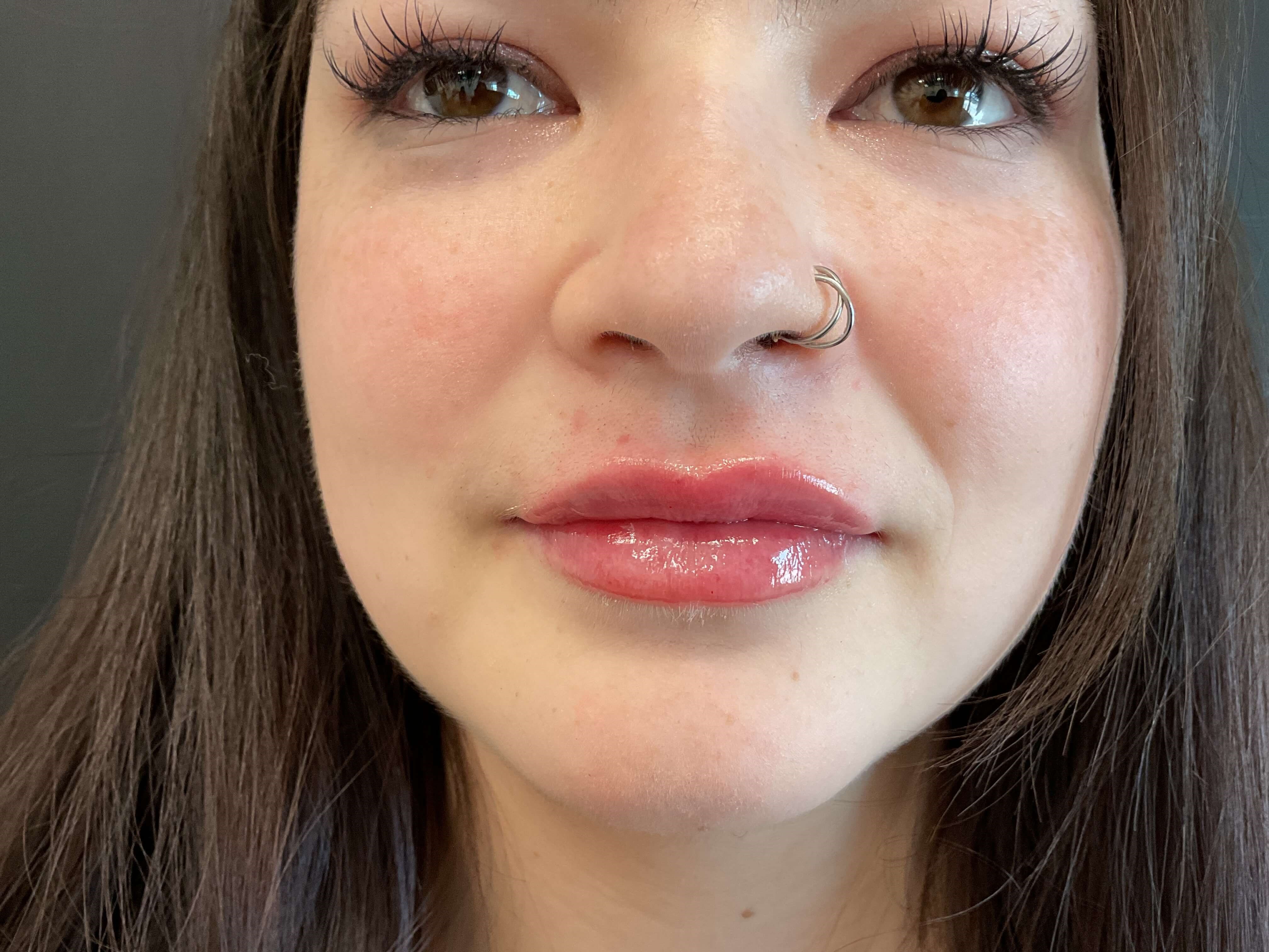 Juvéderm Volbella, lip filler After