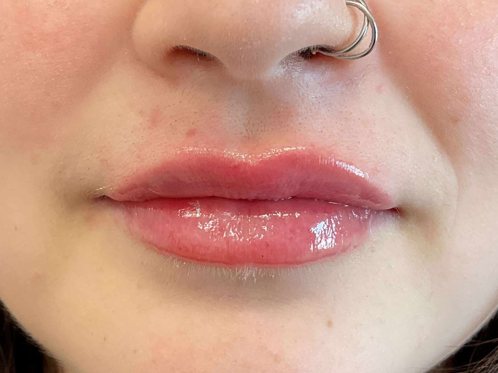 Juvéderm Volbella, lip filler After