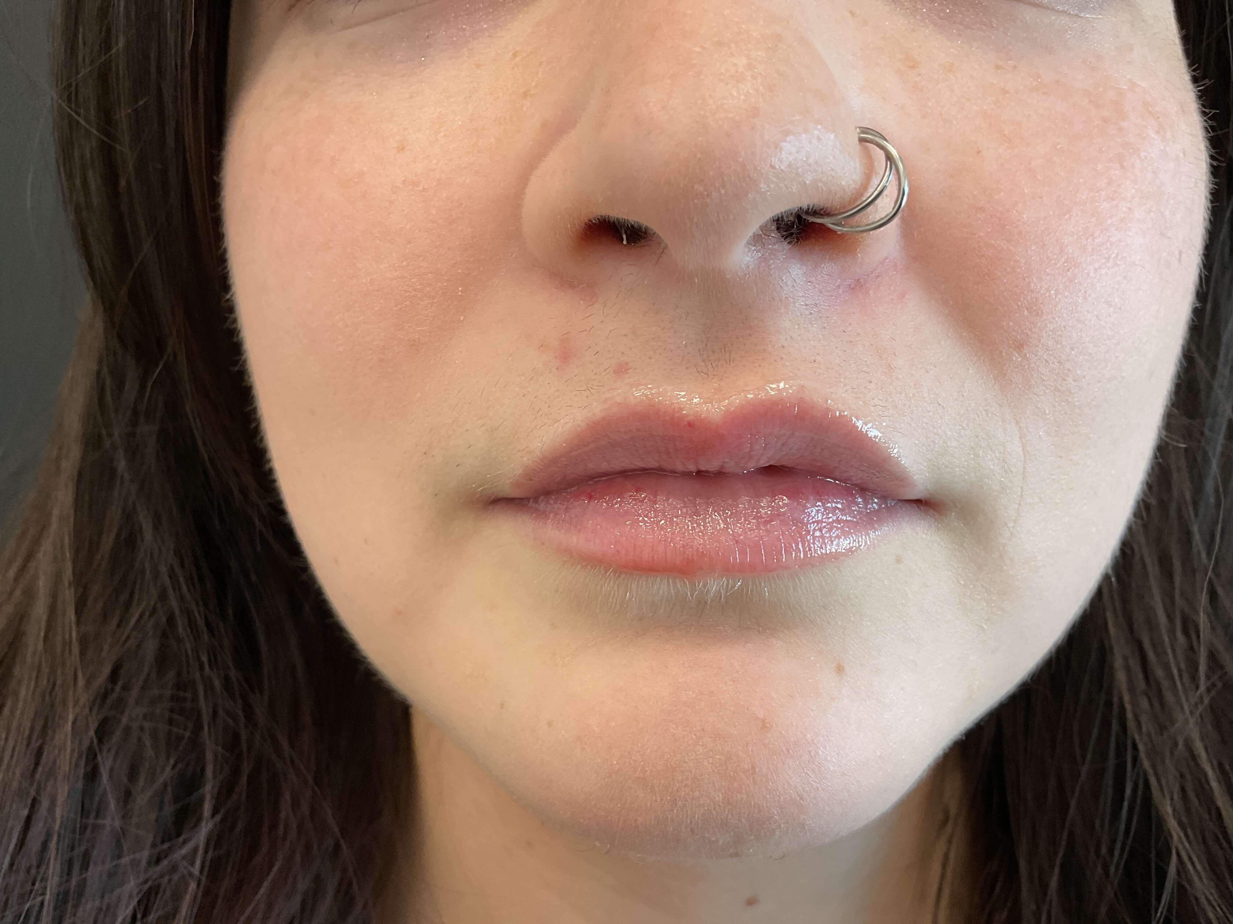 Juvéderm Volbella, lip filler Before