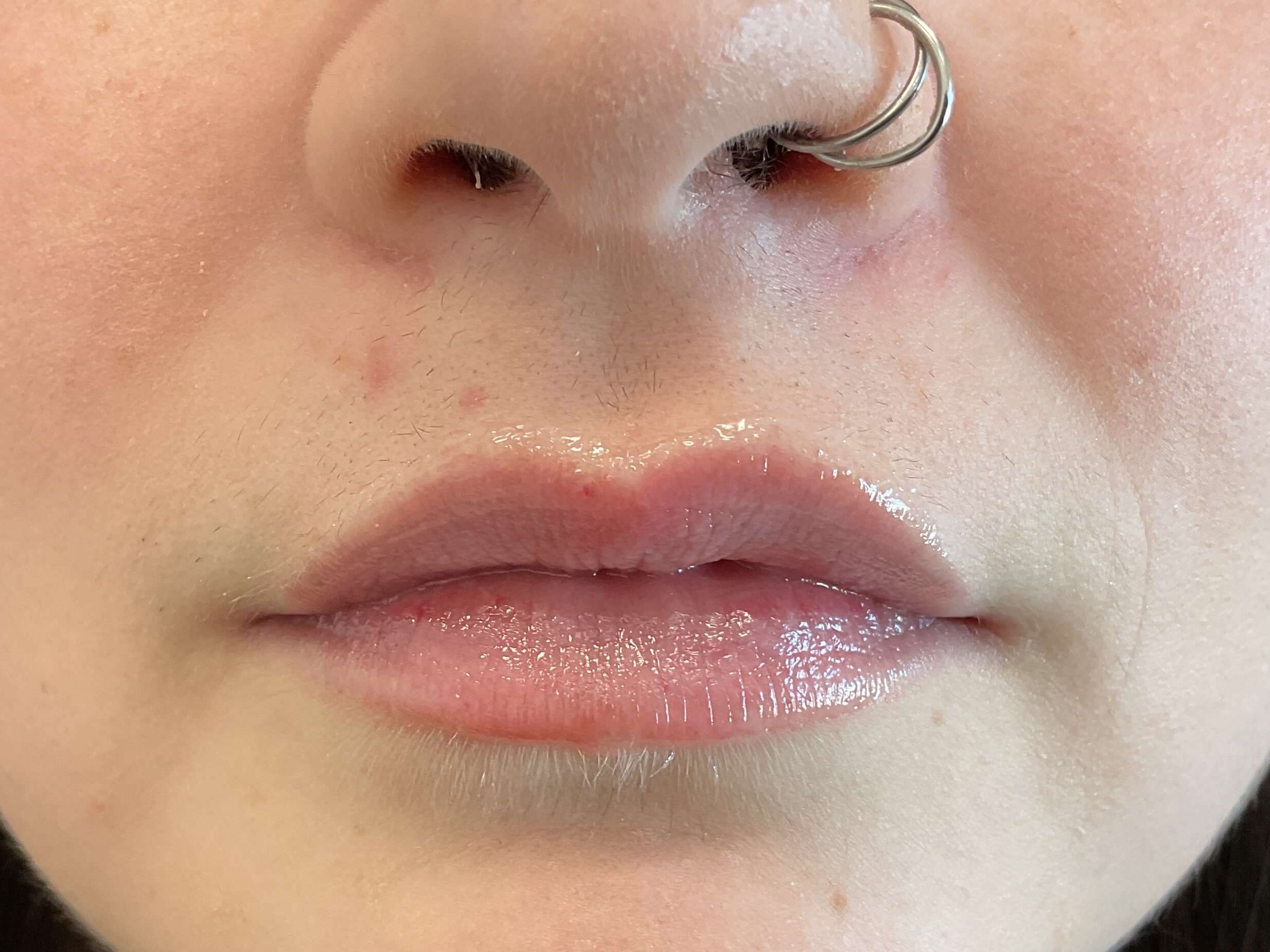 Juvéderm Volbella, lip filler Before