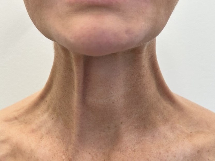 Botox for Platysmal Bands Before