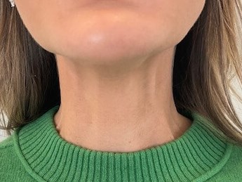 Botox for Platysmal Bands After