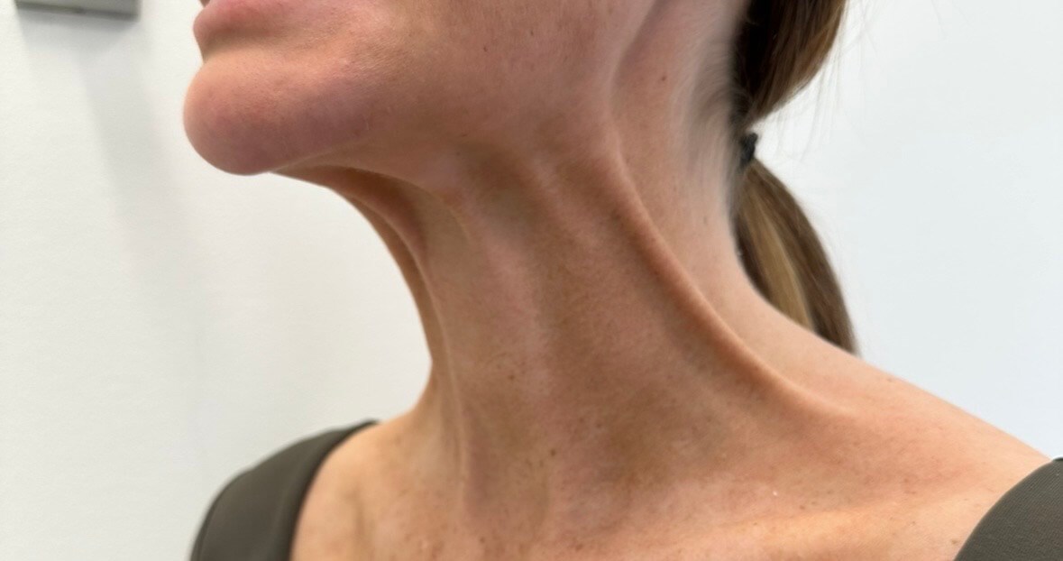 Platysmal Bands Botox Before