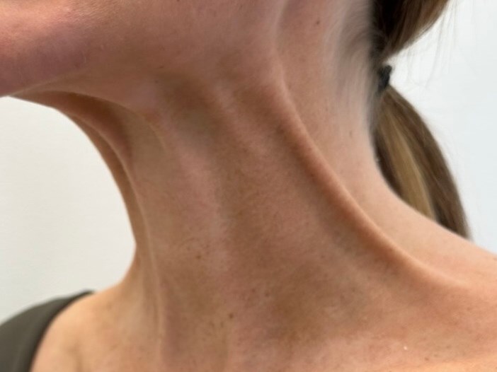 Platysmal Bands Botox Before